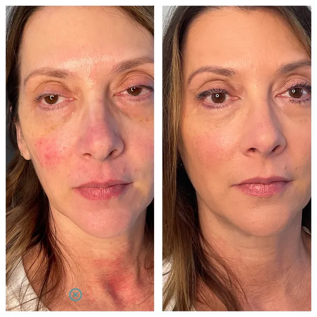 Sculptra Treatment Results